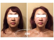 美極 銀座店/銀座/小顔コルギ/小顔矯正