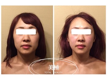 美極 銀座店/銀座/小顔コルギ/小顔矯正