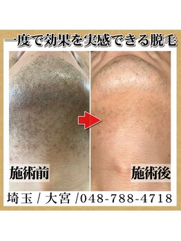 トワ 大宮(TOWA)/~脱毛・症例写真~個人差あり