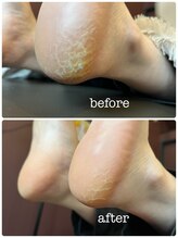 カラン(KARAN)/ひび割れかかと