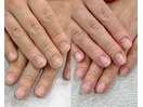 【深爪矯正】綺麗な縦長爪へ♪