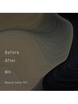 ゴーマルイチ(501)/メンズ脱毛 Before/After