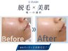 【顔脱毛したい方向け】無料カウンセリング+初回来店特典『肌診断』付き