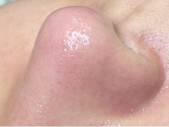 ティーティービューティ 名古屋金山店(TTBeauty)の写真/大人気《肌育!ララピール》ファンデいらずの艶肌/水光肌に!毛穴/赤ら顔/ごわつき…高美容成分でお手入れ◎