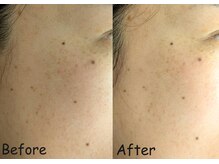 マインドール/シミが気になる40代女性