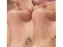 レイ エステティック 江南店(RAY ESTHETIC)/毛穴洗浄×顔脱毛