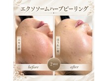 スカイ(sky)の雰囲気（隠す肌から見せたくなる素肌へ。ハーブピーリング2回でこの変化）
