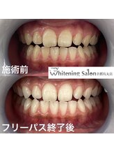 ホワイトニングサロン 京都烏丸店/ホワイトニング施術例