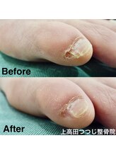 上高田つつじ整体院/フットケア　副爪ケア　施術例