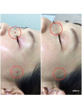 シェアキ(Chez Aki)/シミケアBefore/After