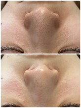 アルモ(ALMO)/美容液毛穴洗浄フェイシャル