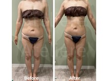 アトリエール(Ateliere)/インディバ130分全身痩身(初回)