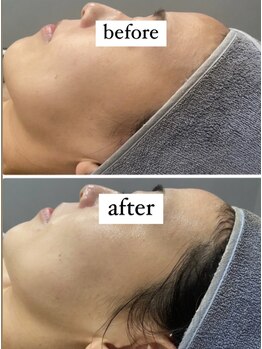 サラ(Sarah)/ハーブピーリングREVI