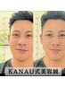 【リフトアップ×たるみ改善】KANAU式美容鍼60分¥16500→¥12100