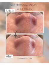 トイロ(toiro)/毛穴洗浄　ハイドラスキン