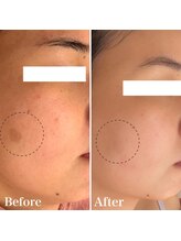 【シミケア/ハーブピーリング専門店】パールホワイトニングサロン　大船店/大きいシミ改善も一緒に！