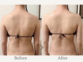 エミィ(emmy)/たった1回で変化！Before→After