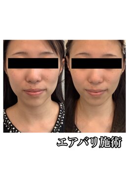 美バリサロン &nbsp;天神店/エアバリフェイシャル