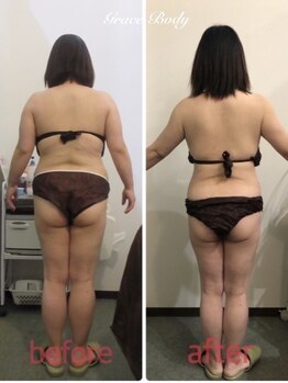 痩身脱毛専門店 グレイスボディ MEGAドンキホーテ三郷店(Gracebody)/◆痩身　症例写真