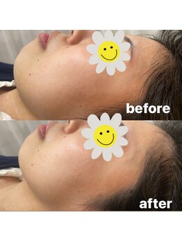 ピエール ナリタイラボ 薬院店(Piel NARITAI LABO)/フェイスラインすっきり！