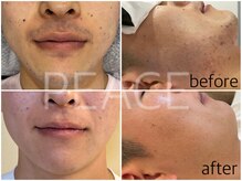 ピース(PEACE)/ひげ脱毛