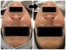 エフェクト 塚口店(effect)/Before After &nbsp;&nbsp;40代/1回目