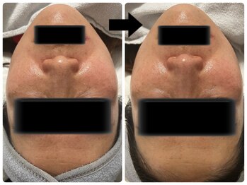 エフェクト 塚口店(effect)/Before After 40代/1回目