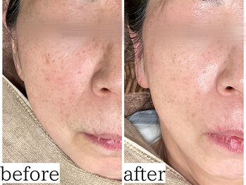 アンドナップ(nap)/スキンケアと脱毛が同時に!