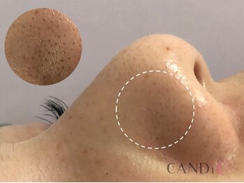 キャンディ 岐阜(CANDi)/ハイドラピーリング/黒ずみ毛穴