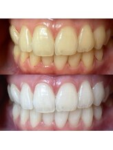 ワールドビューティー(World Beauty)/プレミアムホワイトニング