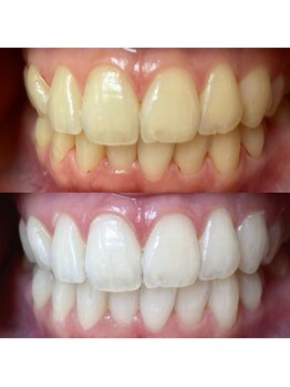 ワールドビューティー(World Beauty)/プレミアムホワイトニング