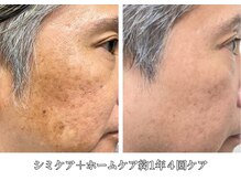 男女関係なし！シミケア目元・口元も施術可能！