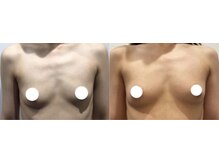 ラーナ(Lana)/【バストアップ】症例♪