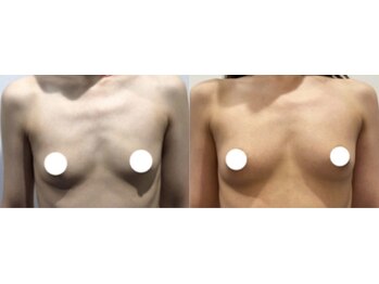 ラーナ(Lana)/【バストアップ】症例♪