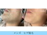 【カミソリ負け/青ヒゲ 卒業！】最新THR脱毛！ヒゲ脱毛¥11,000→¥5,500