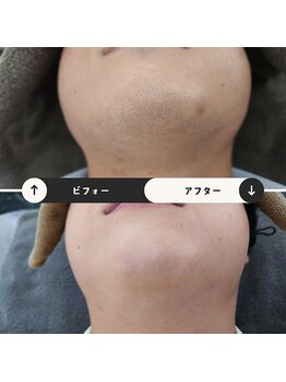 ジュゴン(Dugong)/ヒゲ脱毛（Before＆After）