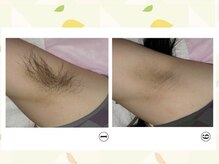 ベル(Belle+vi)/脇脱毛♪