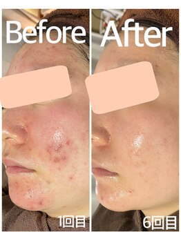 おうちサロン ミキ/BeforeAfterピーリング