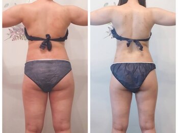 ニコルビー(Nicole Bee)/背中ケア