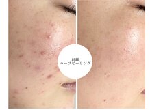 ベル(Belle)の雰囲気（お肌がチクチクしますが頑固なニキビや跡におすすめです！）