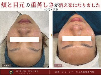 セレニア ボーテ(Selenia Beaute)の写真/9割以上の方が変化を実感。ほうれい線・フェイスラインのもたつきに。大人の肌を見極めるリフトケア