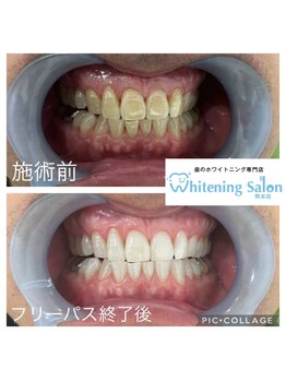 ホワイトニングサロン 熊本店/誰でもホワイトニング