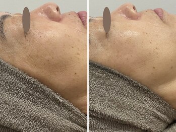 カプリス(CAPRiCE)/BBLフェイシャル