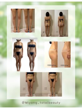 ミヨン(Miyong)/新メニュー!!痩身メニュー追加