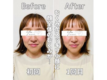 鍼灸整体院ユー(鍼灸整体院You...)/美容鍼×小顔矯正　施術後の変化