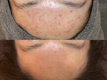 ビジュープラス 広島店(Bijou+)/【20代/ニキビ肌】