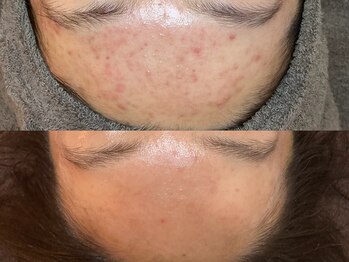 ビジュープラス 広島店(Bijou+)/【20代/ニキビ肌】