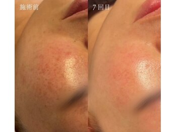 オリエンタルビューティー(ORIENTAL BEAUTY)/プラズマフェイシャル