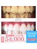 【1番人気★最強☆白さも価格も大満足★20回コースで自信UP♪】1来店2回照射