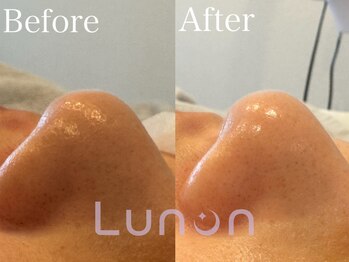 ルノン(Lunon)/毛穴洗浄ハイドロ